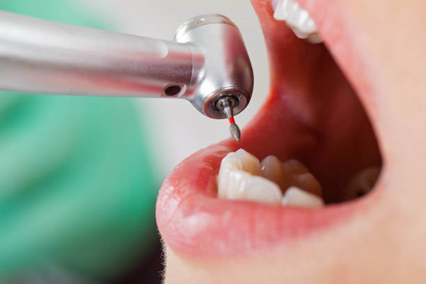 Best Emergency Broken Tooth Repair in Mescal, AZ